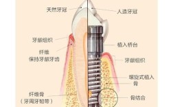 种牙植骨图解详细展示哪些种植修复关键步骤？