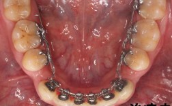 TMD患者正畸治疗