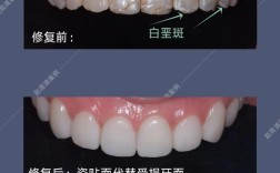 瓷贴面修复方法的关键步骤有哪些？