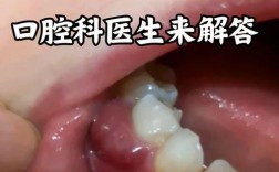 牙龈脓肿的治疗方法有哪些？不同严重程度的治疗方案有何区别？是否需要联合药物与手术干预？家庭护理如何辅助缓解症状？