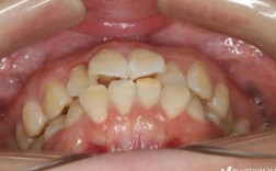 龅牙拔牙正畸视频