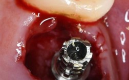 拔牙很久后种牙，会有哪些影响和注意事项？