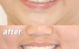 牙齿稀疏正畸案例