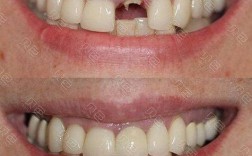 种植牙种出来像龅牙，是种植体位置问题还是医生操作失误？