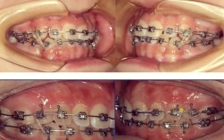 矫正牙齿上下挂皮筋的作用是什么？需要一直戴吗？