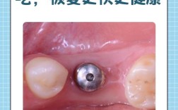 种牙能真正恢复牙齿原样吗？