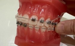 网上牙齿矫正器效果如何？真的有用吗？