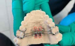 正畸扩弓用弓丝