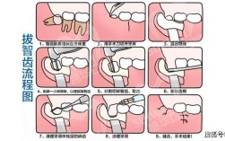 成人智齿拔除方法