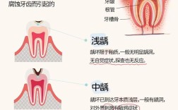 儿童龋齿治疗有哪些方法？不同龋坏程度如何选？