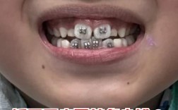 儿童矫正牙齿会反弹吗