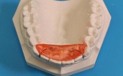 口腔正畸导板图片