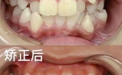 汉中市牙齿矫正哪家好