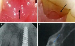 正畸炎症牙根吸收