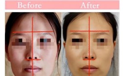 正畸能改变颧骨吗