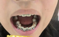 矫正牙齿不戴牙套可行吗？有哪些替代矫正方式？