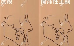 掩饰性正畸 正颌
