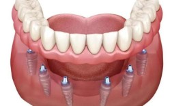 一次种6颗种植牙真的安全吗？需要满足哪些牙槽骨条件？手术风险和术后恢复期会如何？