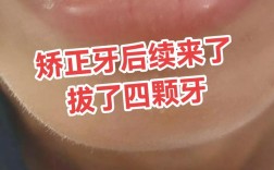 6号牙拔了能矫正牙齿