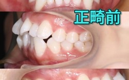 矫正后发现怀孕，牙齿矫正还能继续吗？