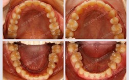 武汉同济矫正牙齿效果如何？医生靠谱吗？价格贵不贵？