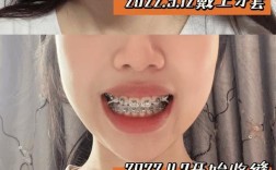 牙齿矫正没什么感觉？这是正常现象吗？