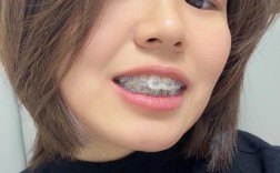 23岁矫正牙齿晚不晚