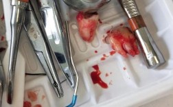 尽头牙拔牙的方法有哪些具体操作步骤？