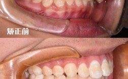 上海龅牙矫正怎么选？效果靠谱吗？费用多少？