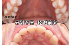 牙齿不整齐不想矫正，还有其他办法吗？