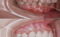 拔牙后可以矫正牙齿