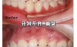 牙齿排列不齐矫正？如何选对矫正方式达到理想效果？