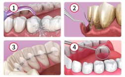 牙周刮治的操作方法具体包含哪些步骤？不同牙周情况的操作技巧有何差异？如何确保治疗过程中的安全与效果？