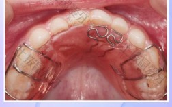 矫正牙齿为什么要上弹簧？它到底有啥用？