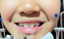 天津成年反颌正畸可行吗？效果与注意事项有哪些？