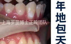 上海青少年牙齿矫正