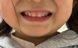 牙齿矫正后牙龈突出是什么原因导致的？