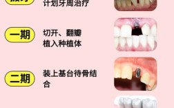 种牙哪里种得好？关键看这几点，你选对医院医生了吗？