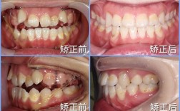 牙齿矫正后为何会错位？原因分析与处理方法