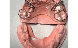 正畸指簧是什么