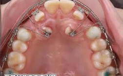 牙齿矫正颌间牵引