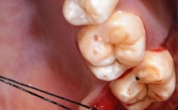 正畸后智齿冒头？原因何在？如何应对？