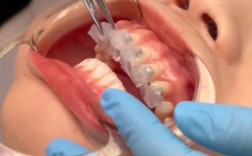 数字化正畸托槽