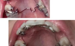 32岁做隐形舌侧正畸，这个年龄矫正效果到底真的会不会受影响呢？