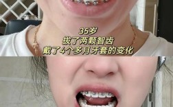 牙齿矫正一般几个月能开始看到效果？之后会越来越明显吗？