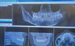 牙齿矫正拍CT是必须的吗？关键作用与检查重点解析