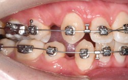 华西口腔正畸补牙