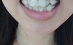 40岁能做牙齿矫正吗？有年龄限制吗？