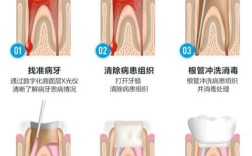 根管消毒五种方法有哪些？各有何特点与临床优势？
