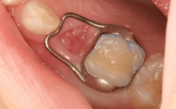 正畸磨牙间间隙为何会出现？需处理吗？